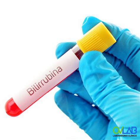 exame de bilirrubina